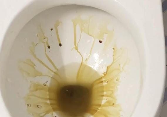 马桶被水垢堵了怎么办（解决马桶水垢堵塞的有效方法）